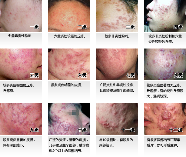 痤疮最严重的_图片上的痘痘算很严重吗 想去医院皮肤科看看会不会小题