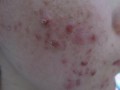 夏季痘痘惹人烦，如何正确护理痘痘呢?