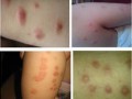夏季丘疹性荨麻疹来势汹汹，该如何预防和护理呢?