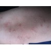 盘点：湿疹症状有哪些？八大典型症状