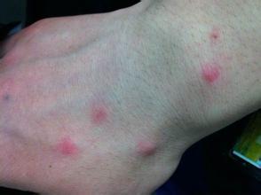 蚊子叮咬的皮肤病