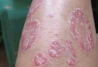 银屑病治疗 专家提醒:不能乱用激素类药物