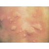 日光性荨麻疹有哪些症状表现