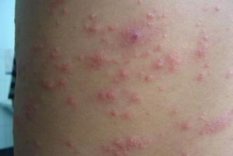 几种常见药疹的皮肤表现类型