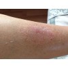 银屑病患者常见哪些表现