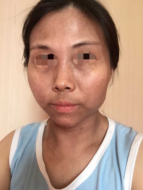黑变病怎样护理