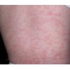 早期玫瑰糠疹的主要症状是什么