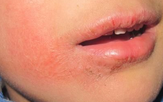 口周皮炎的发病特点有哪些