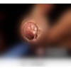 男性得了淋病能不能过性生活