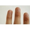 　晚期灰指甲会出现什么症状
