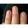 秋季灰指甲的护理方法