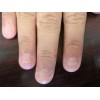 如何针对性的预防灰指甲
