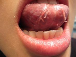 女性尖锐湿疣也会出现在口腔部位吗