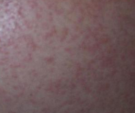 慢性湿疹的症状具体有哪些