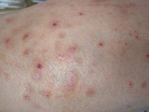 慢性湿疹发病期临床特点