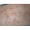 慢性湿疹发病期临床特点