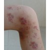 慢性湿疹患者在生活中需有哪些要注意问题呢