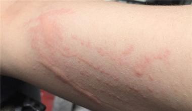 日光性荨麻疹平时该怎么护理