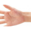 女性手部湿疹怎么预防