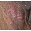 女生殖器疱疹常见症状