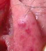 夏季生殖器疱疹为什么容易复发