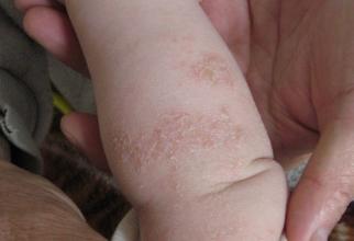 亚急性湿疹有什么症状