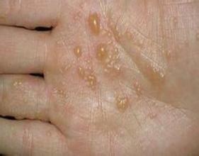 汗疱疹的病因是出汗多吗?