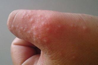 汗疱疹的病因是出汗多吗