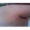 丘疹性荨麻疹应该怎么预防?