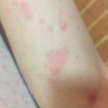 儿童红皮病型牛皮癣致病因素有什么