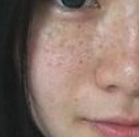 脸上雀斑怎样才能预防