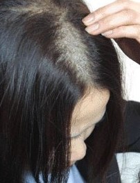 斑秃预防
