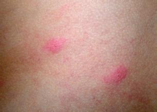 接触性荨麻疹常有什么症状