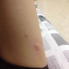 小儿荨麻疹的治疗方法哪个好？