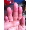 手癣患者该怎么护理自己的双手?