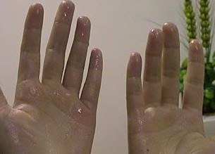 多汗症症状
