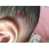血管瘤是什么原因造成的？