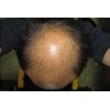 如何预防脂溢性脱发？