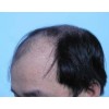 治疗脂溢性脱发的常见的方法