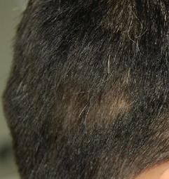 偏方治疗斑秃的方法有哪些