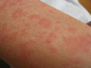 关于皮肤病的问题  湿疹、油性皮肤等该怎么办的解答集锦