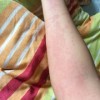 急性荨麻疹的偏方疗法