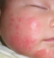 婴儿湿疹如何护理