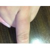 怎样预防硬皮病