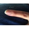要注意掌跖脓疱型银屑病