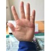 小儿掌跖脓疱病的致病因素是什么