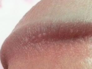 女性治疗尖锐湿疣的注意事项