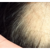 斑秃大多数是由哪些原因导致