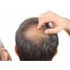 几种预防脱发的方法