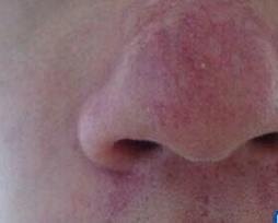 酒渣鼻的常见症状主要有哪些呢